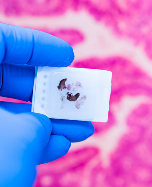 FFPE Human Tissue Samples Reliable and Long-Term Solutions for Biomedical Research